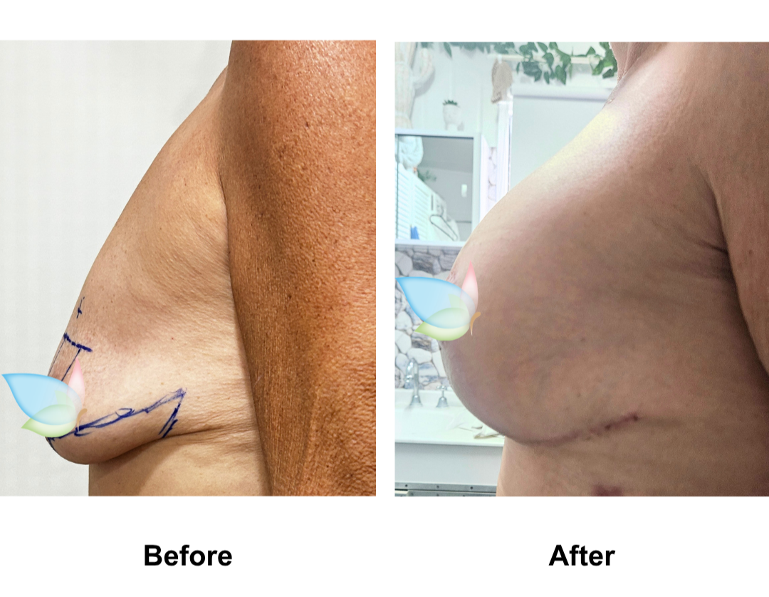 Nicole had BABL (Motiva Demi  265) with Dr. Weerachai (2)