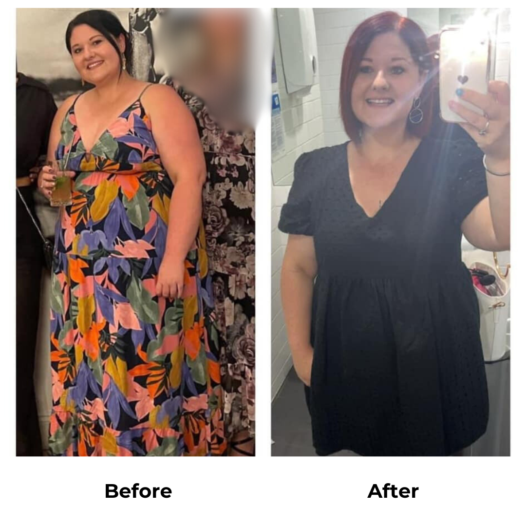 Nicole had gastric sleeve surgery (2)