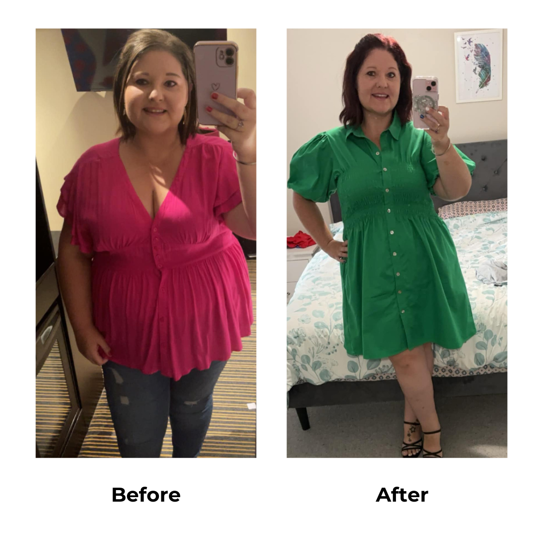 Nicole had gastric sleeve surgery