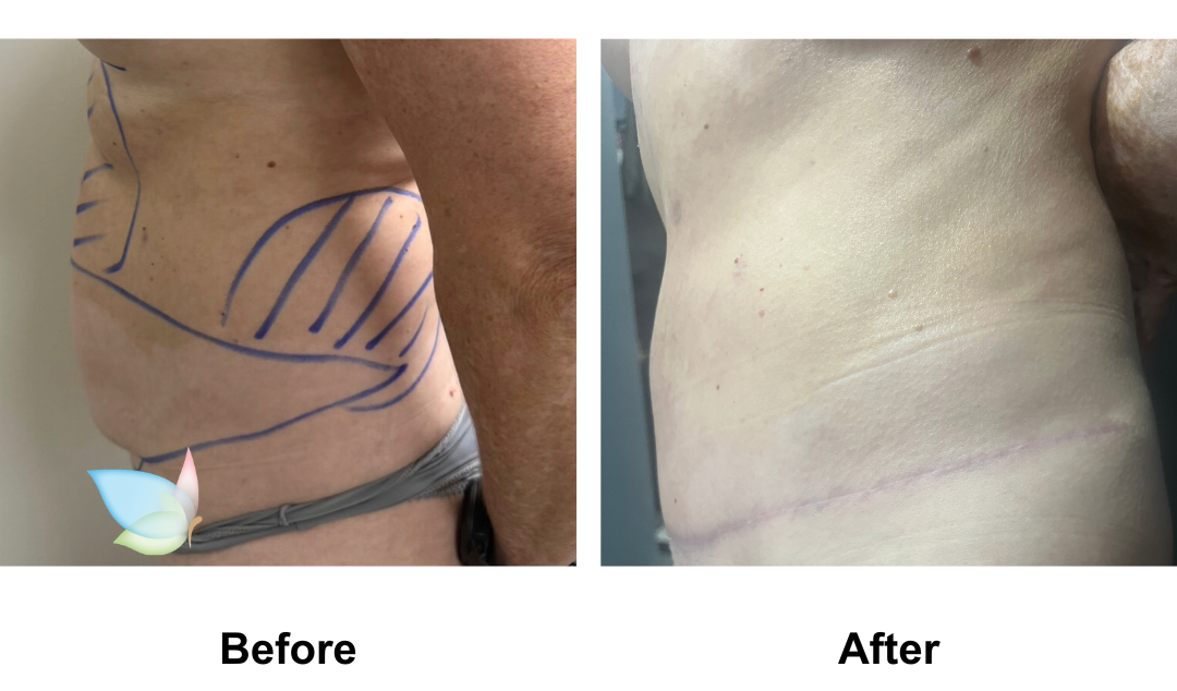 Nicoleen had Extended tt + Mon lift, Lipo on upper abdomen and love handles with Dr. Ring (2)