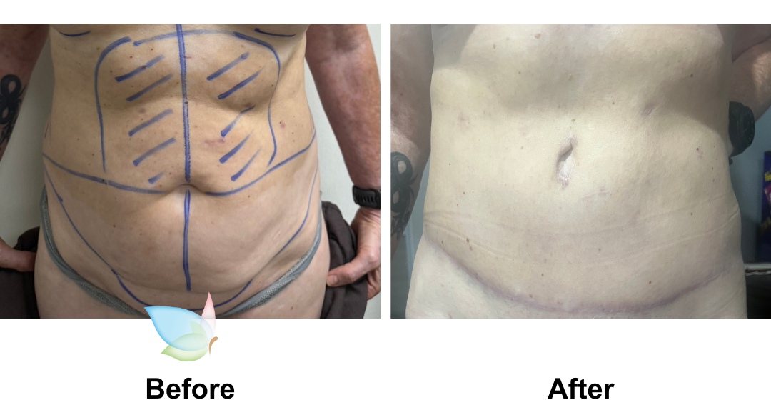 Nicoleen had Extended tt + Mon lift, Lipo on upper abdomen and love handles with Dr. Ring