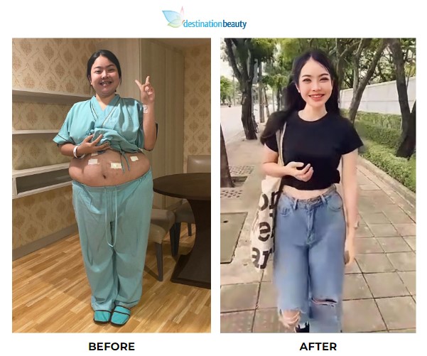 Nittaya weight loss surgery 2