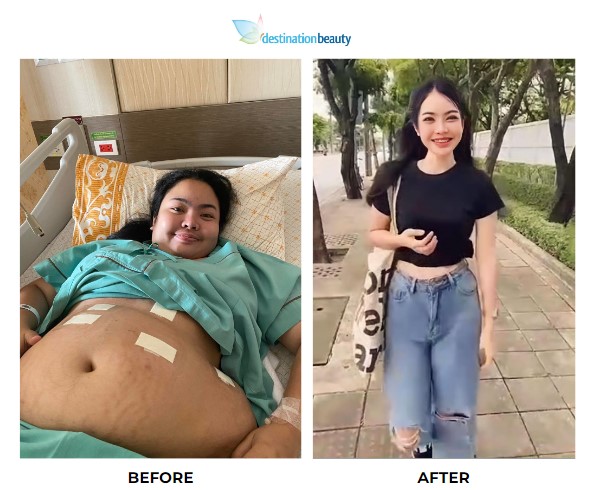 Nittaya weight loss surgery