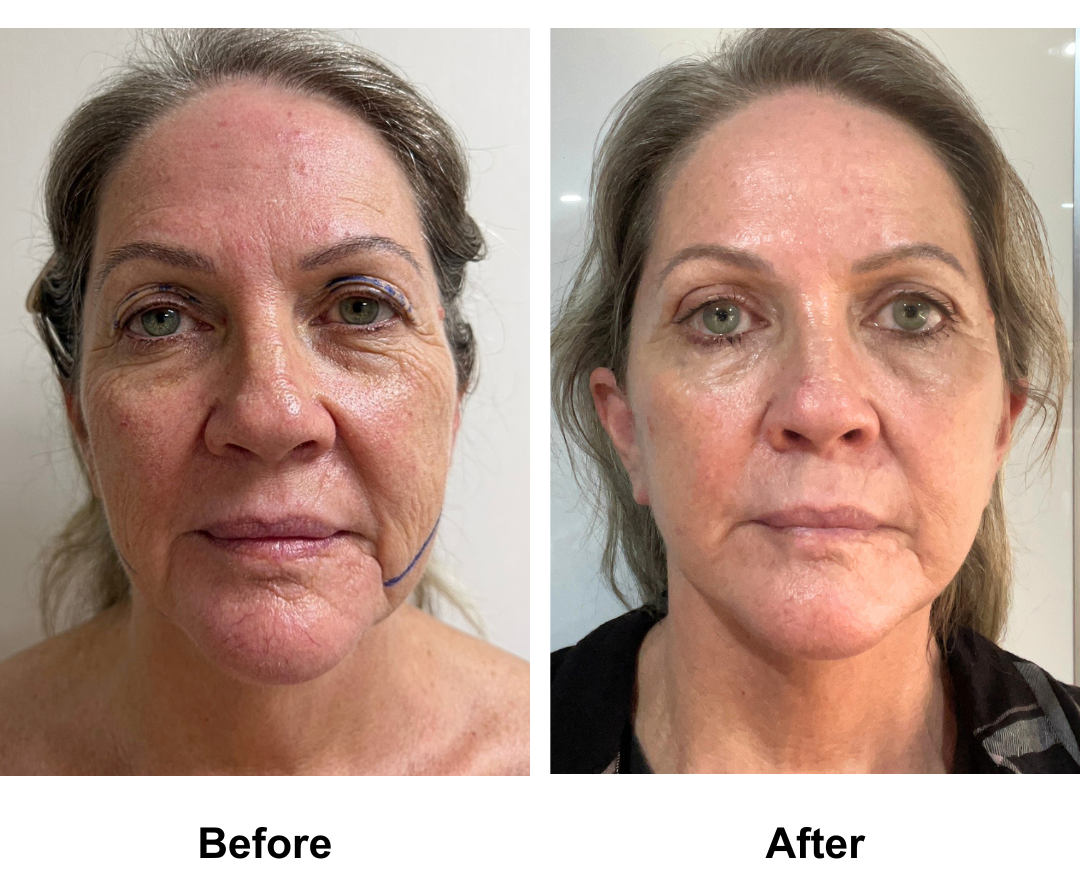 Noeleen had MFNL + Chin lift + UB with Dr. Ring  (1)