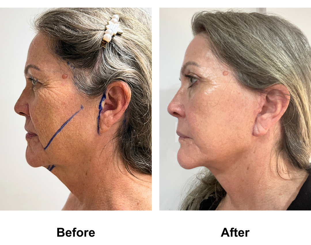 Noeleen had MFNL + Chin lift + UB with Dr. Ring