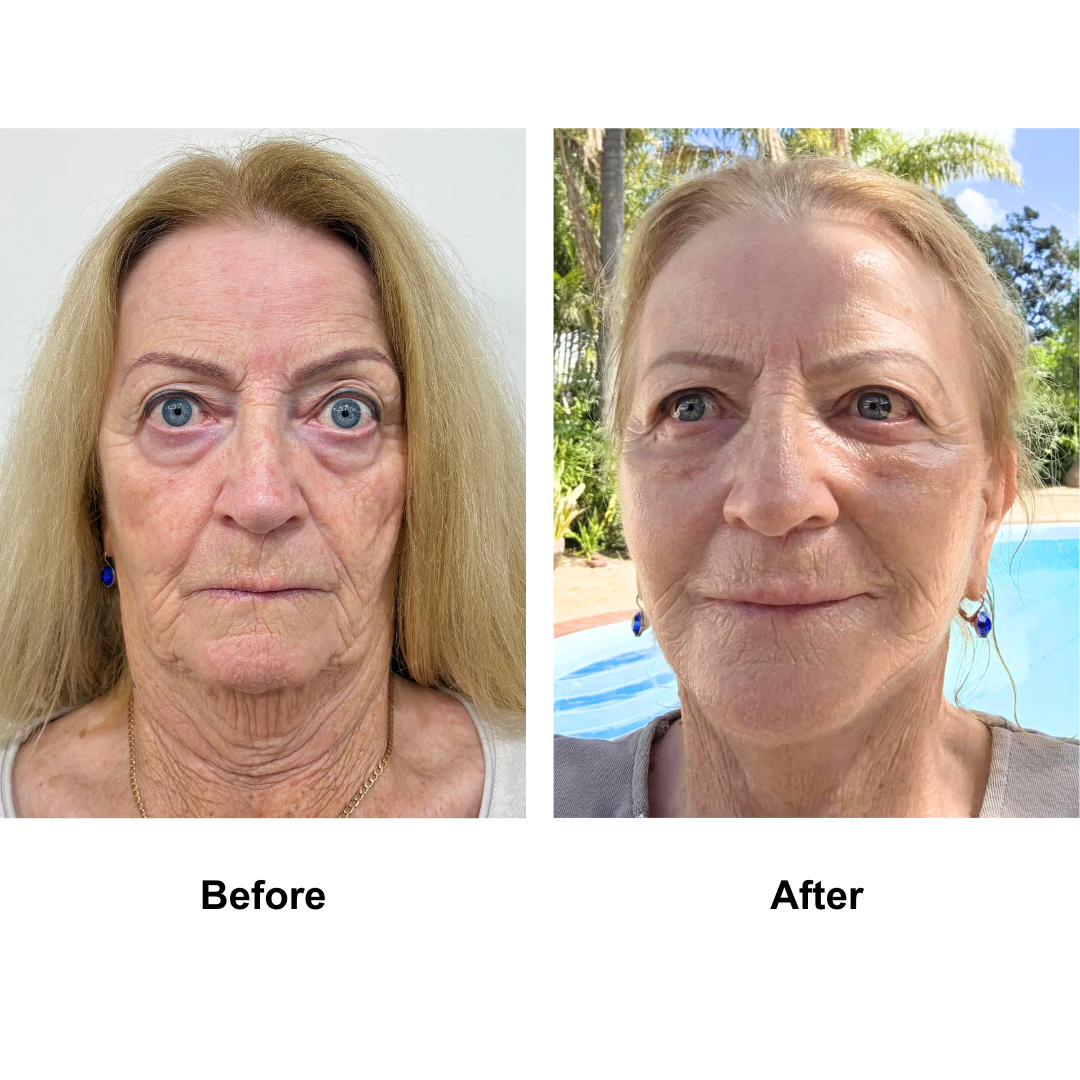 Pamela had FFNL+ Lipo chin + UB+LB+  Fat transfer to face with Dr. NJ (1)