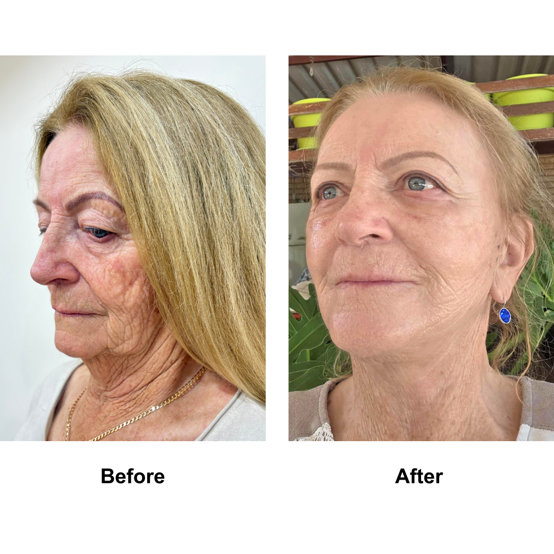 Pamela had FFNL+ Lipo chin + UB+LB+  Fat transfer to face with Dr. NJ