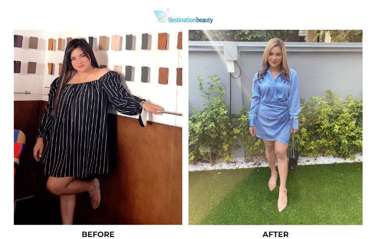 Penthip weight loss surgery 2