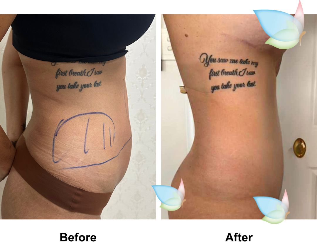 Petrina had ExTT + Lipo2 (upper abs, love handles) with Dr. Ring