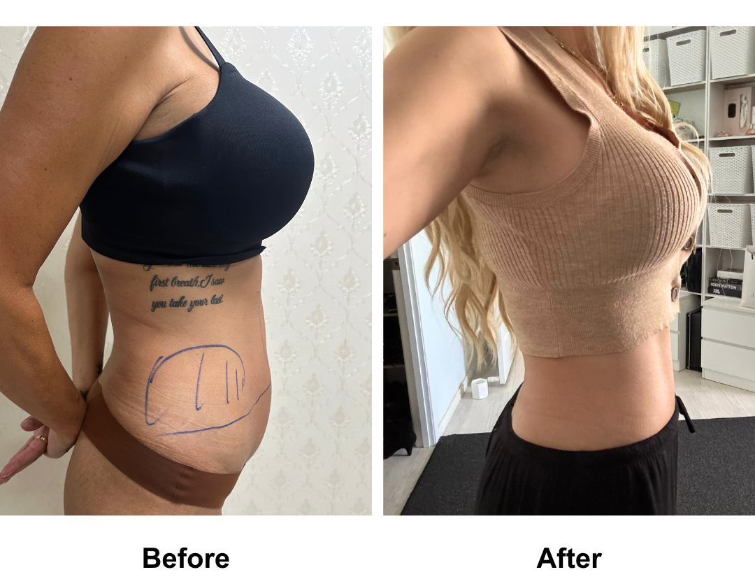 Petrina had ExTT + Lipo_2 (upper abs, love handles) with Dr. Ring (2)
