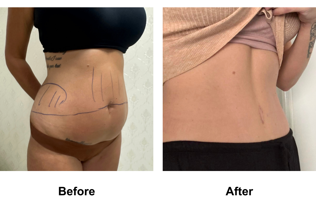 Petrina had ExTT + Lipo_2 (upper abs, love handles) with Dr. Ring