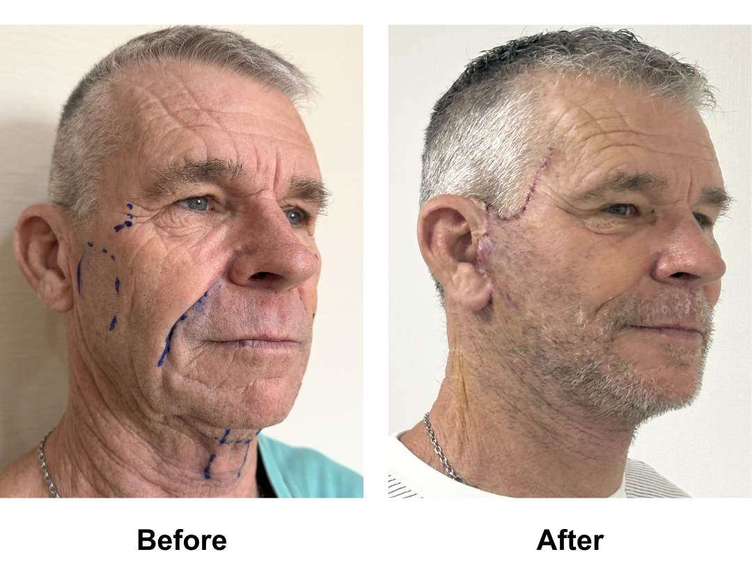 Philip had FFNL + Chin Lift with Dr. Pasu (1)