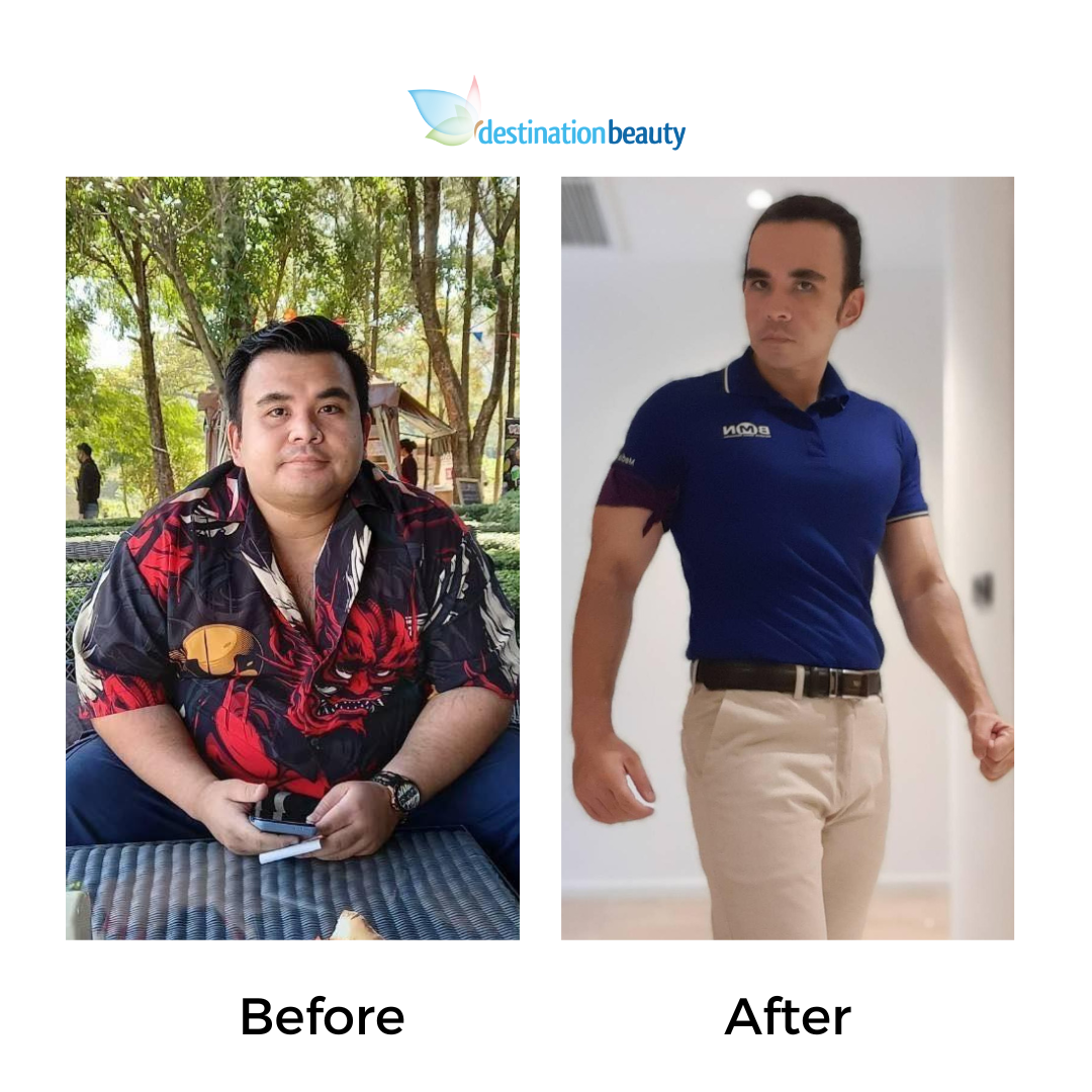 Prakasit had gastric sleeve (2)