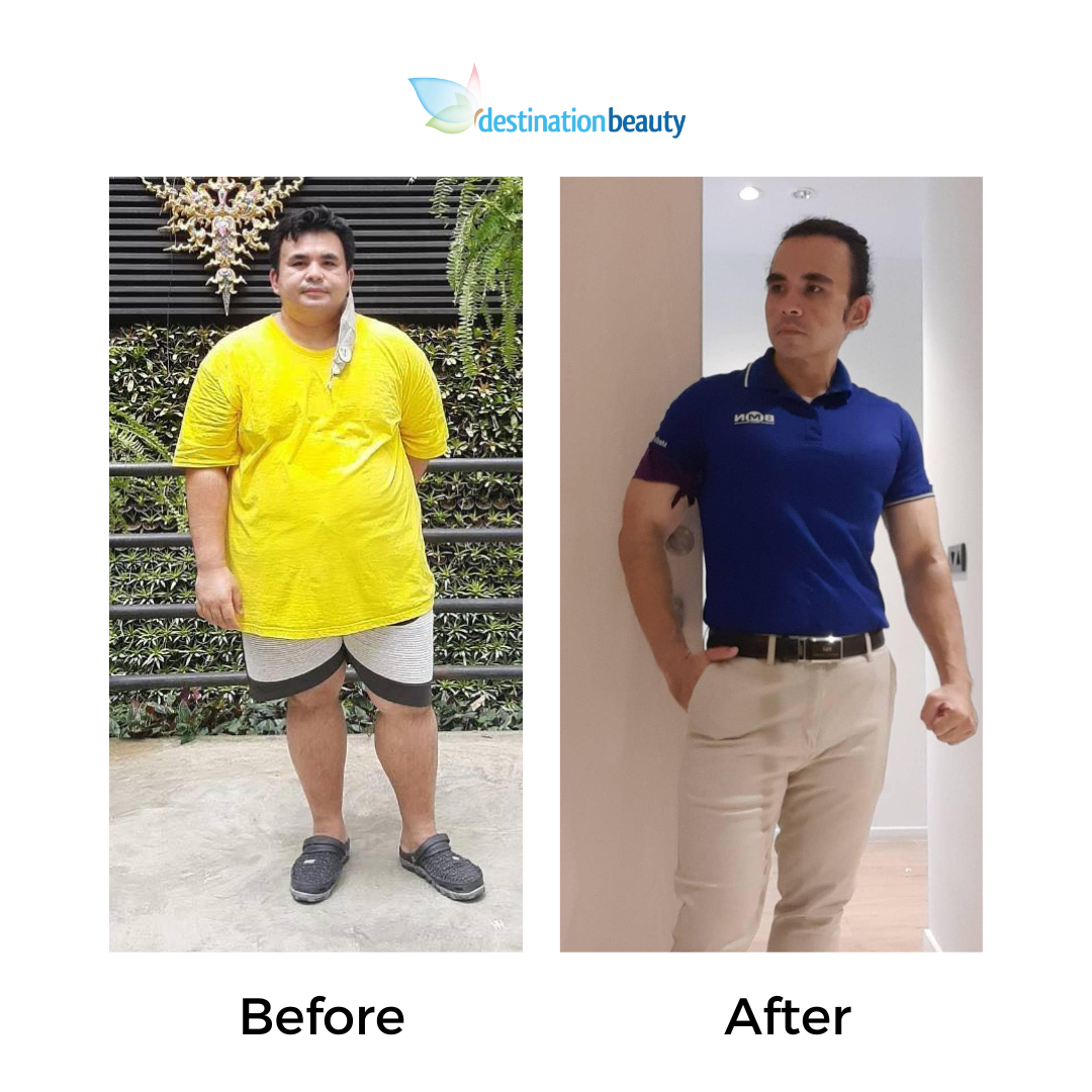 Prakasit had gastric sleeve