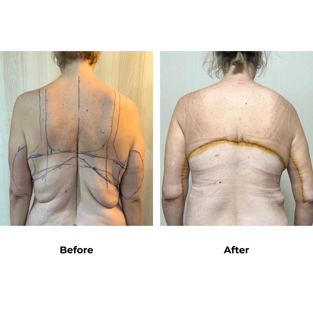 Prue had BABL+AL+Braline+ETT+Lipo3 with Dr. Angkana (2)