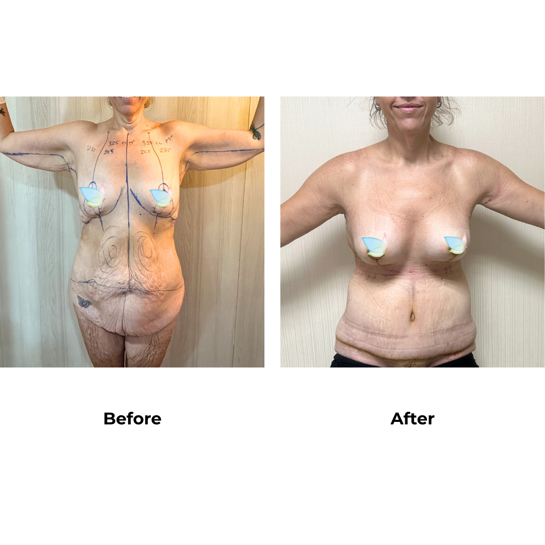Prue had BABL+AL+Braline+ETT+Lipo3 with Dr. Angkana