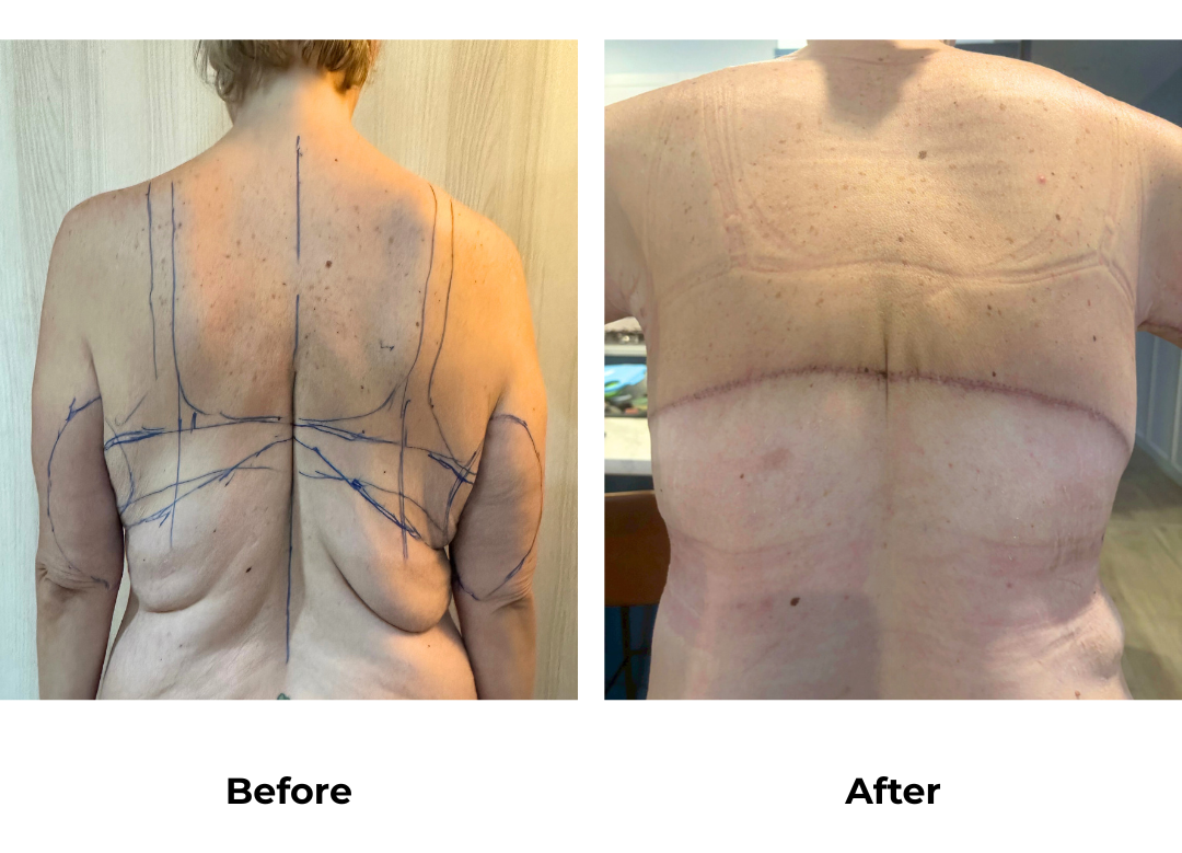 Prue had BABL+AL+Braline+ETT+Lipo3 with Dr. Angkana - 1 month (1)