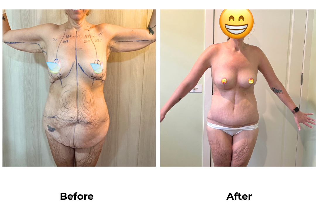 Prue had BABL+AL+Braline+ETT+Lipo3 with Dr. Angkana - 1 month (2)