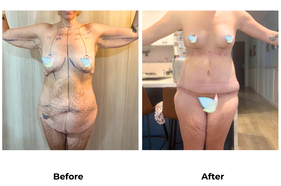 Prue had BABL+AL+Braline+ETT+Lipo3 with Dr. Angkana - 1 month
