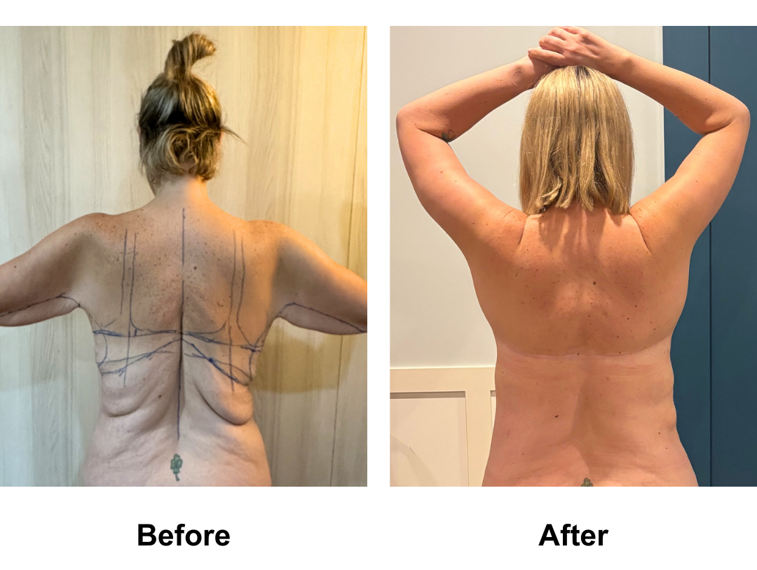 Prues 1 year post-op skin removal with Dr. Angkana (1)