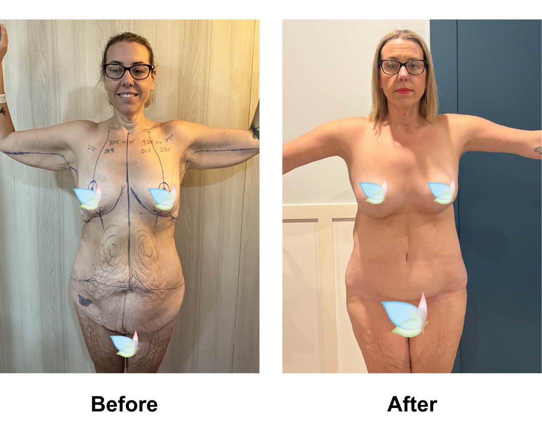 Prues 1 year post-op skin removal with Dr. Angkana