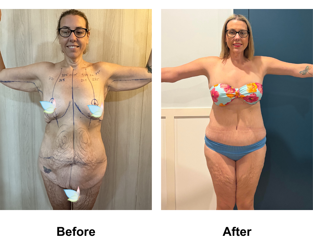 Prues 1 year post-op