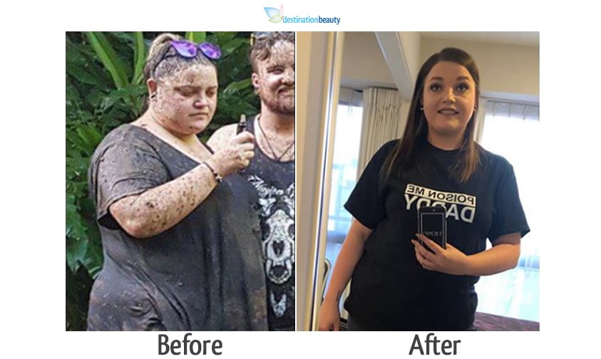 rhiannon weight loss surgery