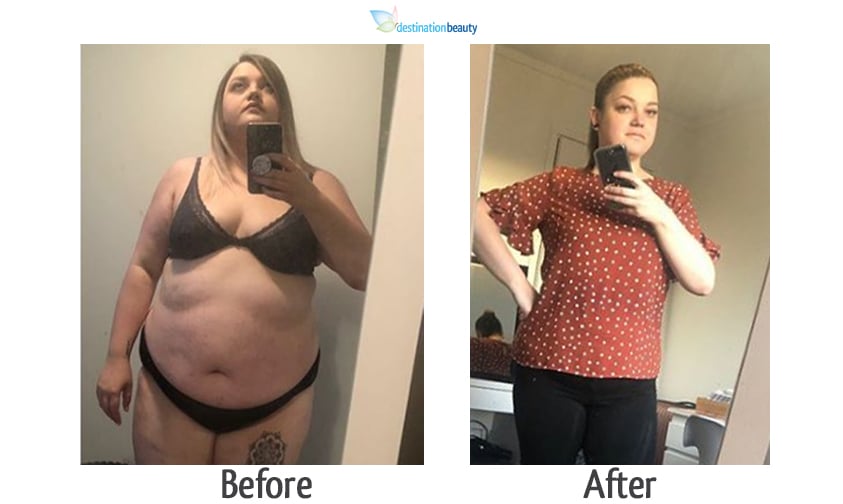 rhiannon weight loss surgery