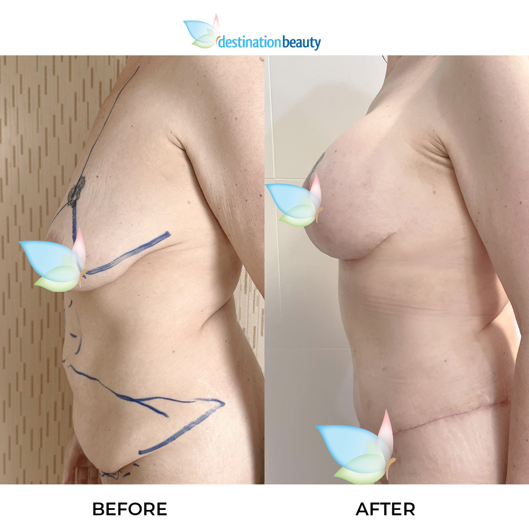 Rachel breast augmentation with lift, extended tummy tuck, lipo 2