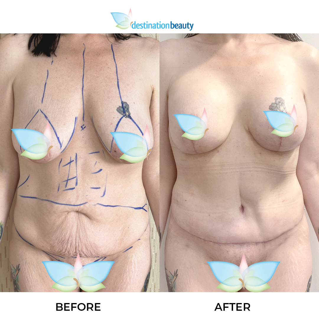 Rachel breast augmentation with lift, extended tummy tuck, lipo 3