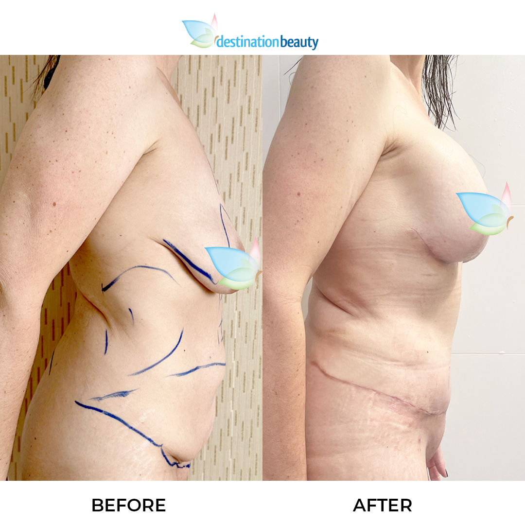 Rachel breast augmentation with lift, extended tummy tuck, lipo