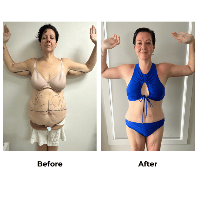 Rachel had ExTT + AL + ML + Lipo x3 with Dr. Weerachai (1)