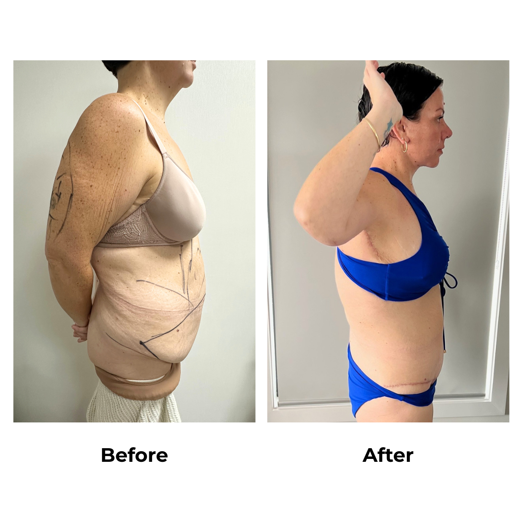 Rachel had ExTT + AL + ML + Lipo x3 with Dr. Weerachai (2)