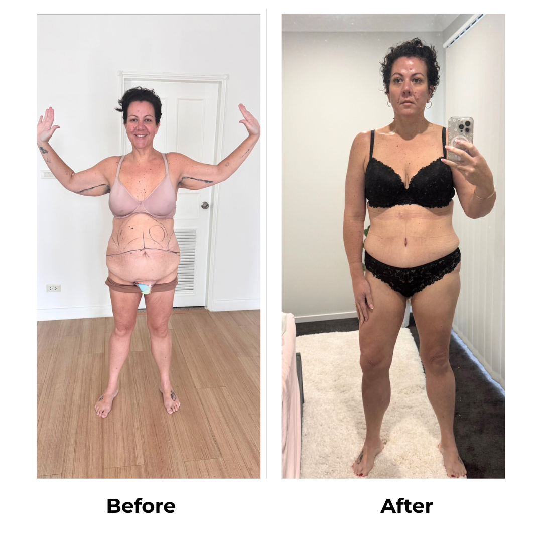 Rachel had ExTT + AL + ML + Lipo x3 with Dr. Weerachai (3)