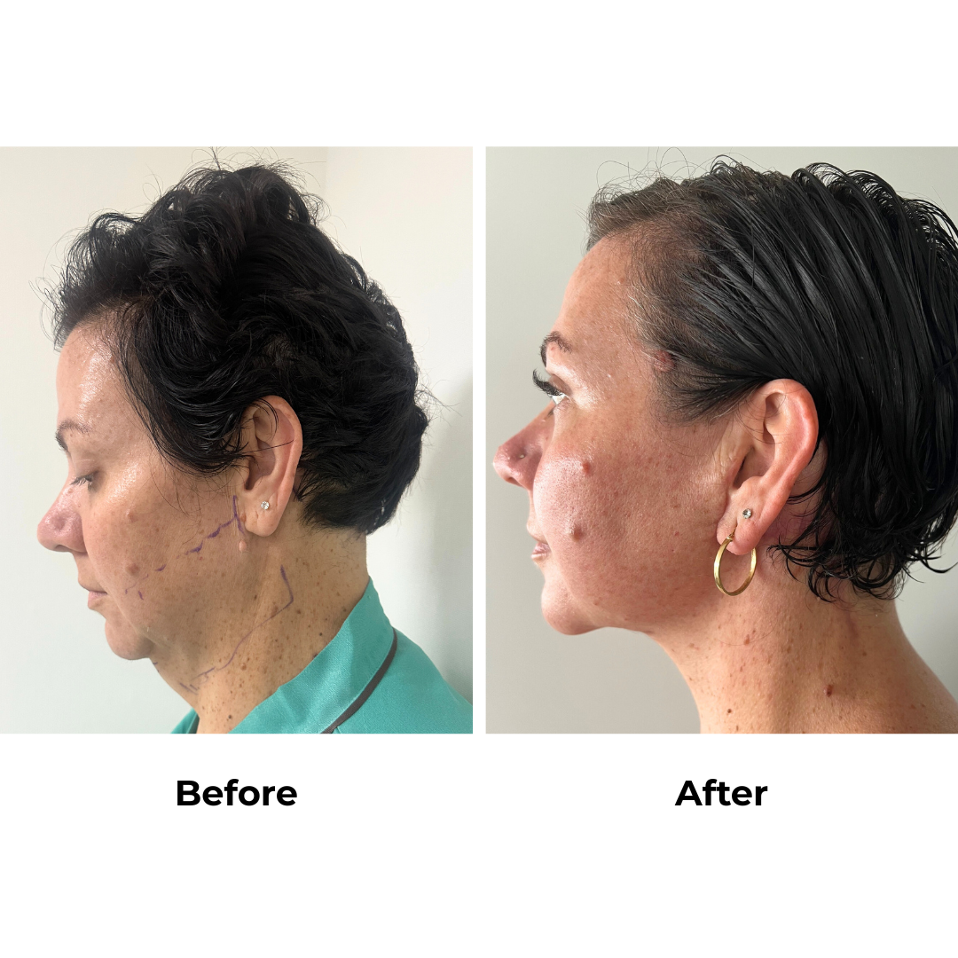 Rachel had Lower face & neck lift + Chin Lift with Dr. Ring (2)