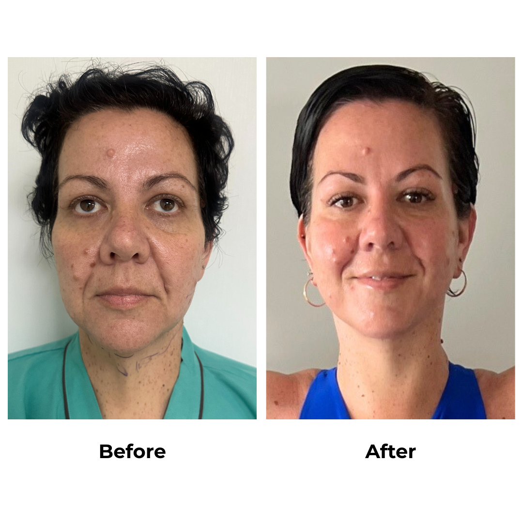 Rachel had Lower face & neck lift + Chin Lift with Dr. Ring (3)