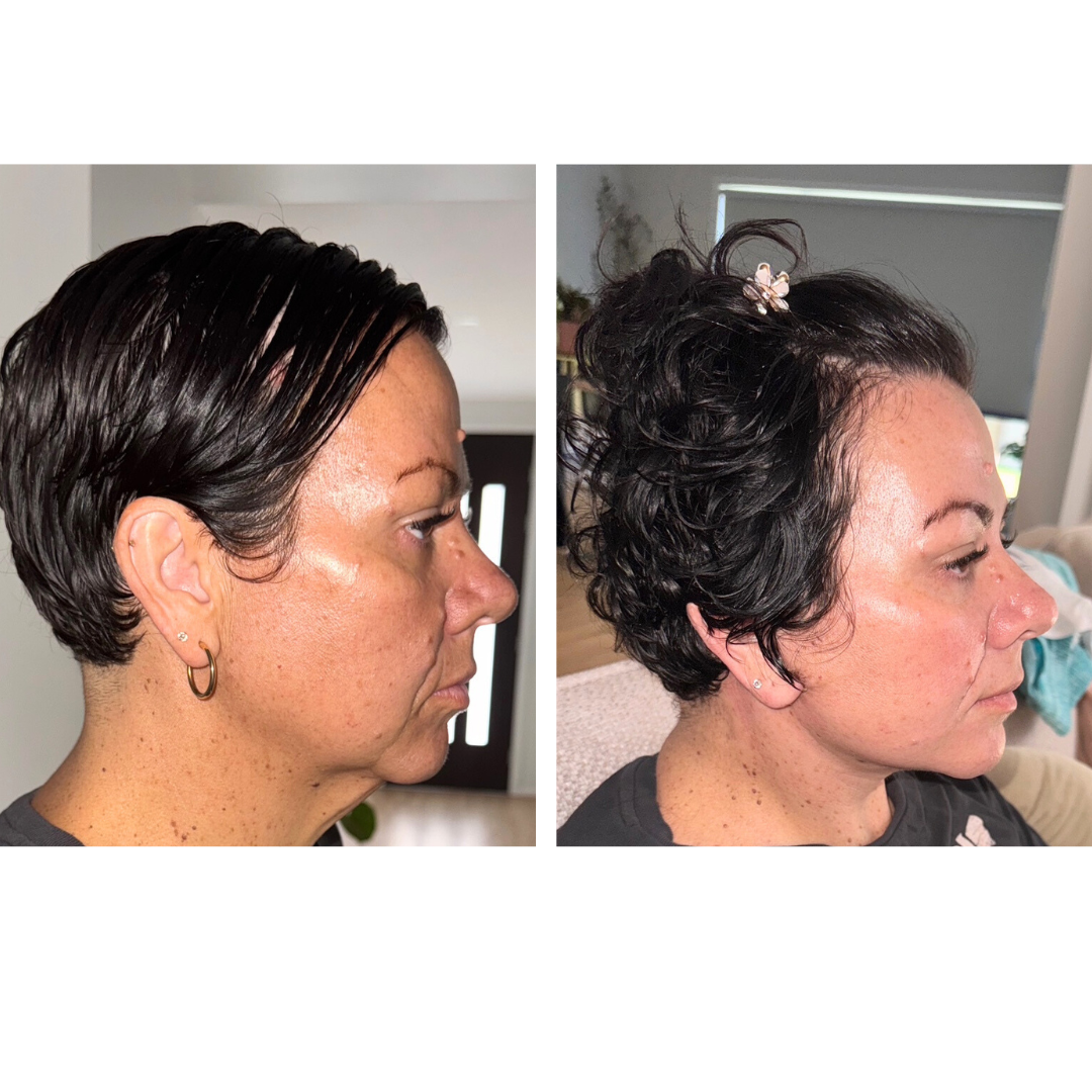 Rachel had Lower face & neck lift + Chin Lift with Dr. Ring