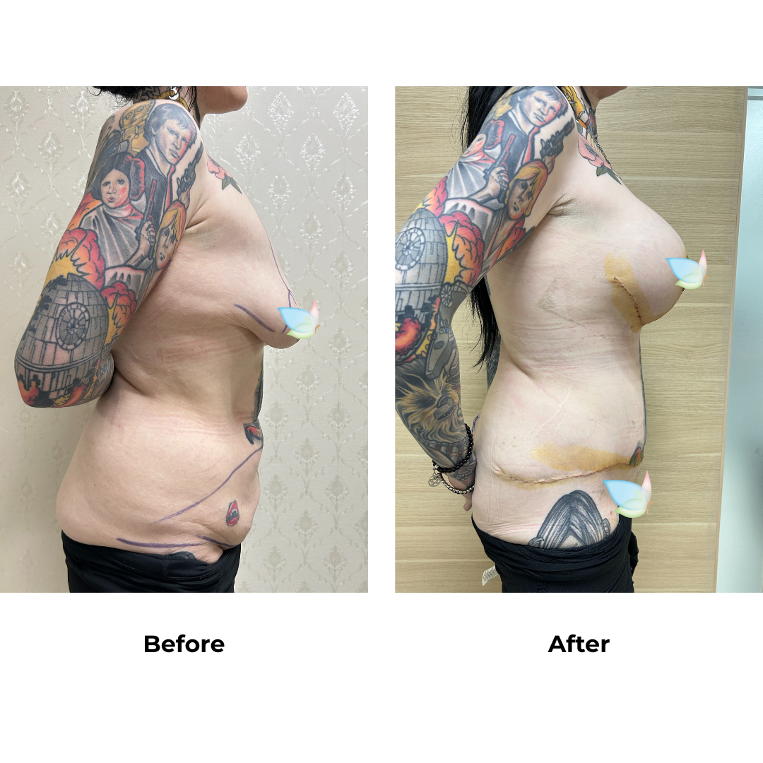 Rachelle had ExTT + Lipo_ + BABL with Dr. Ring (2)