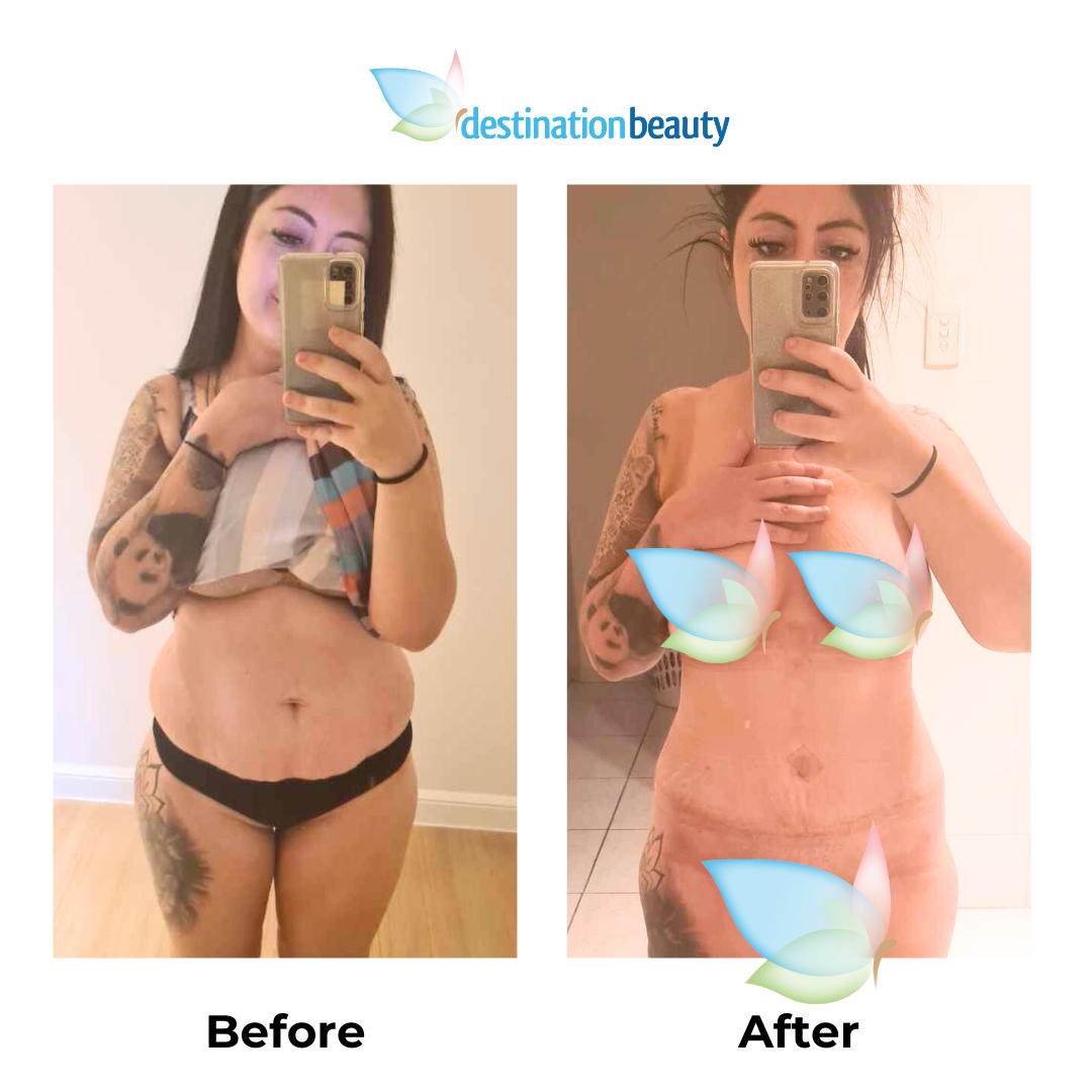 Raechelle 3 weeks post tummy tuck thailand