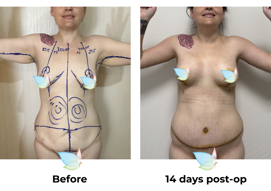 Rebecca had BABL (350 HP) + SL + AL + ExTT + Mons lift + VASER lipo 2 areas on upper abs & love handles with Dr.  Angkana (1)