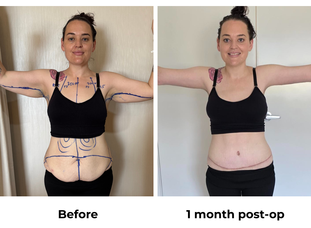 Rebecca had BABL (350 HP) + SL + AL + ExTT + Mons lift + VASER lipo 2 areas on upper abs & love handles with Dr.  Angkana (3)