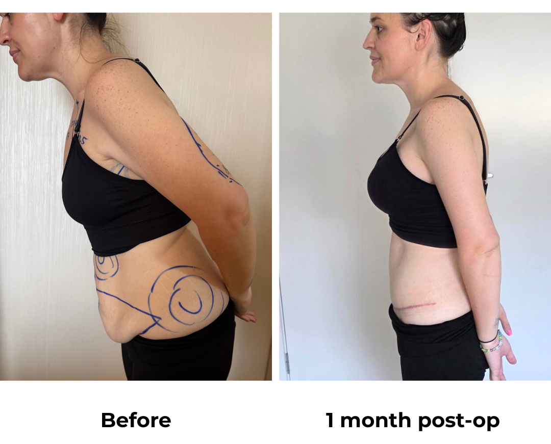 Rebecca had BABL (350 HP) + SL + AL + ExTT + Mons lift + VASER lipo 2 areas on upper abs & love handles with Dr.  Angkana (4)