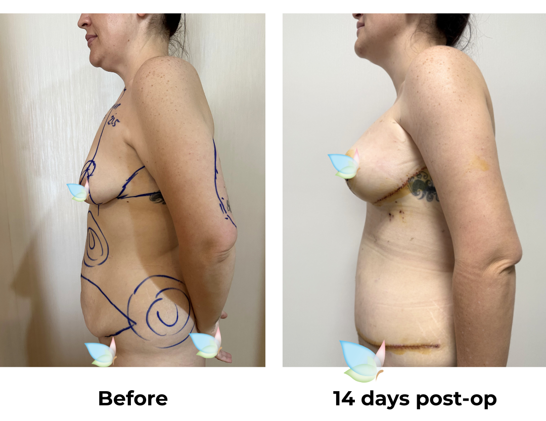 Rebecca had BABL (350 HP) + SL + AL + ExTT + Mons lift + VASER lipo 2 areas on upper abs & love handles with Dr.  Angkana (5)