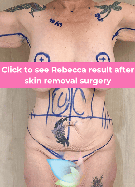 Rebecca skin removal thailand