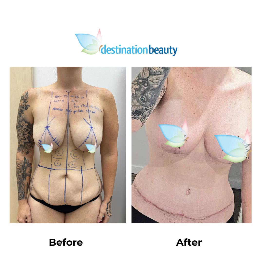 Rebeccas 6 weeks post-skin removal (2)