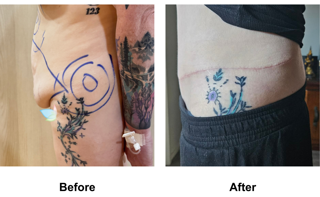 Rebekah had ExTT + Mons lift + Lipo 2 with Dr. Angkana  (1)