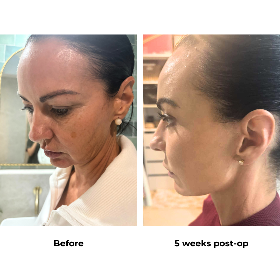 Renee had MFNL + LB + Endo Brow Lift with Dr. Ring  (11)