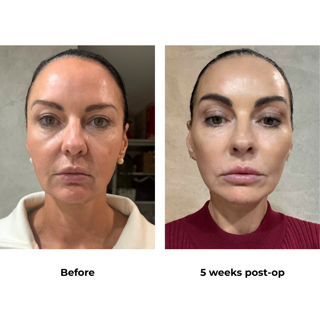 Renee had MFNL + LB + Endo Brow Lift with Dr. Ring  (12)
