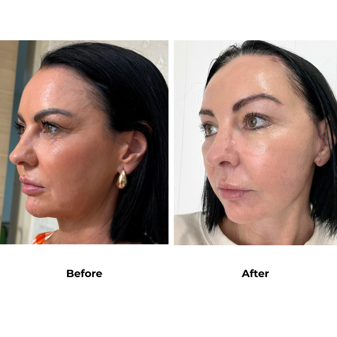 Renee had MFNL + LB + Endo Brow Lift with Dr. Ring  (5)