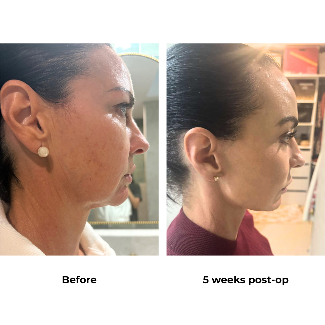 Renee had MFNL + LB + Endo Brow Lift with Dr. Ring  (9)